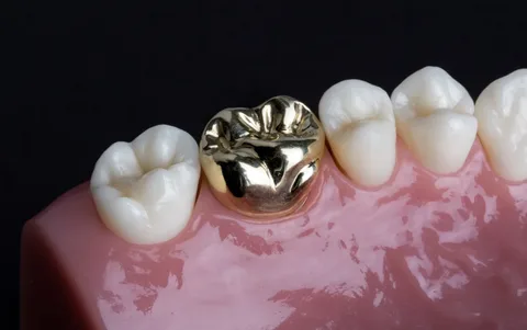 Metal Crowns