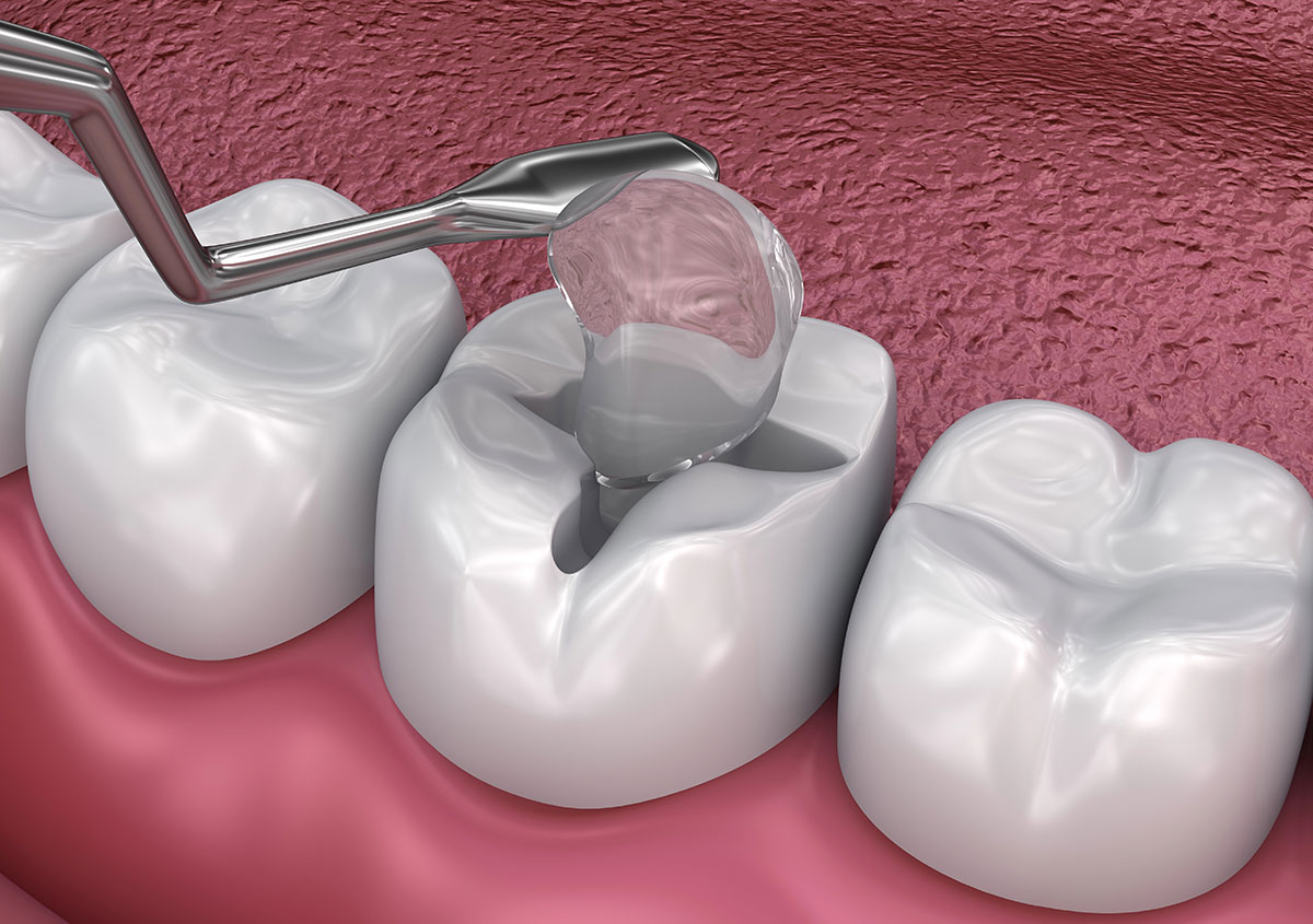 Cavity Filling Process