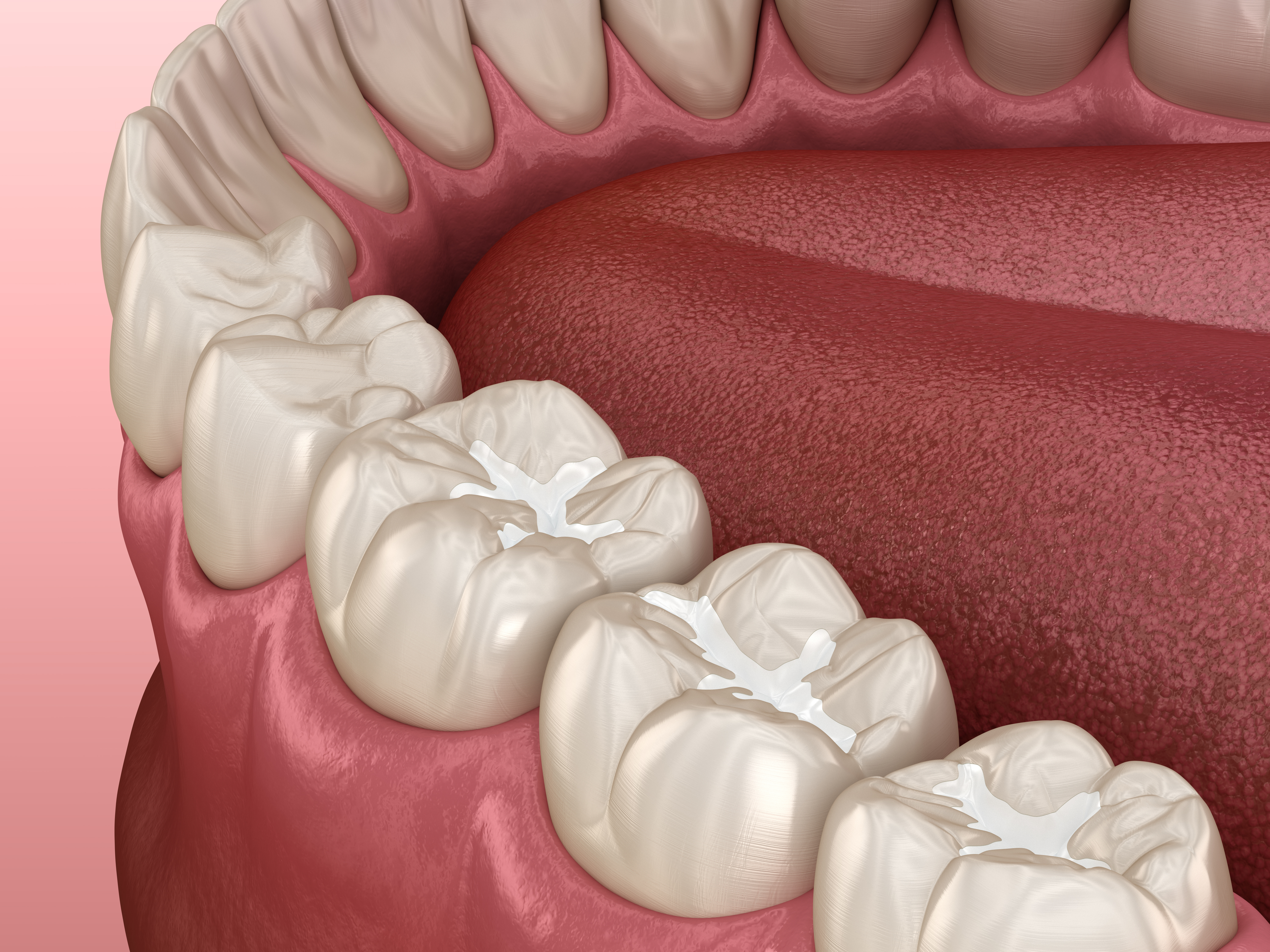 Composite Resin