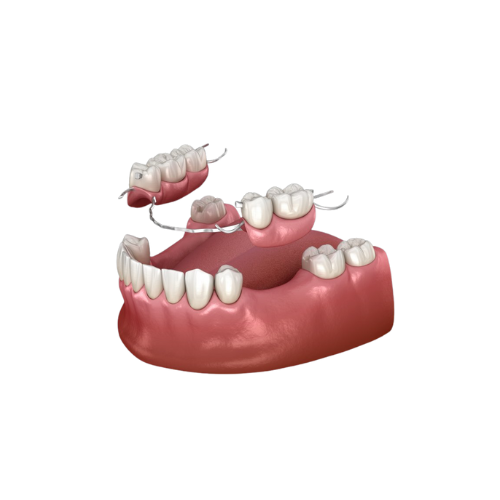 Partial Dentures