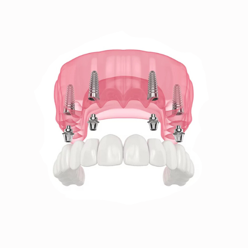 Implant-Supported Dentures