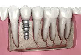 Single Tooth Implant