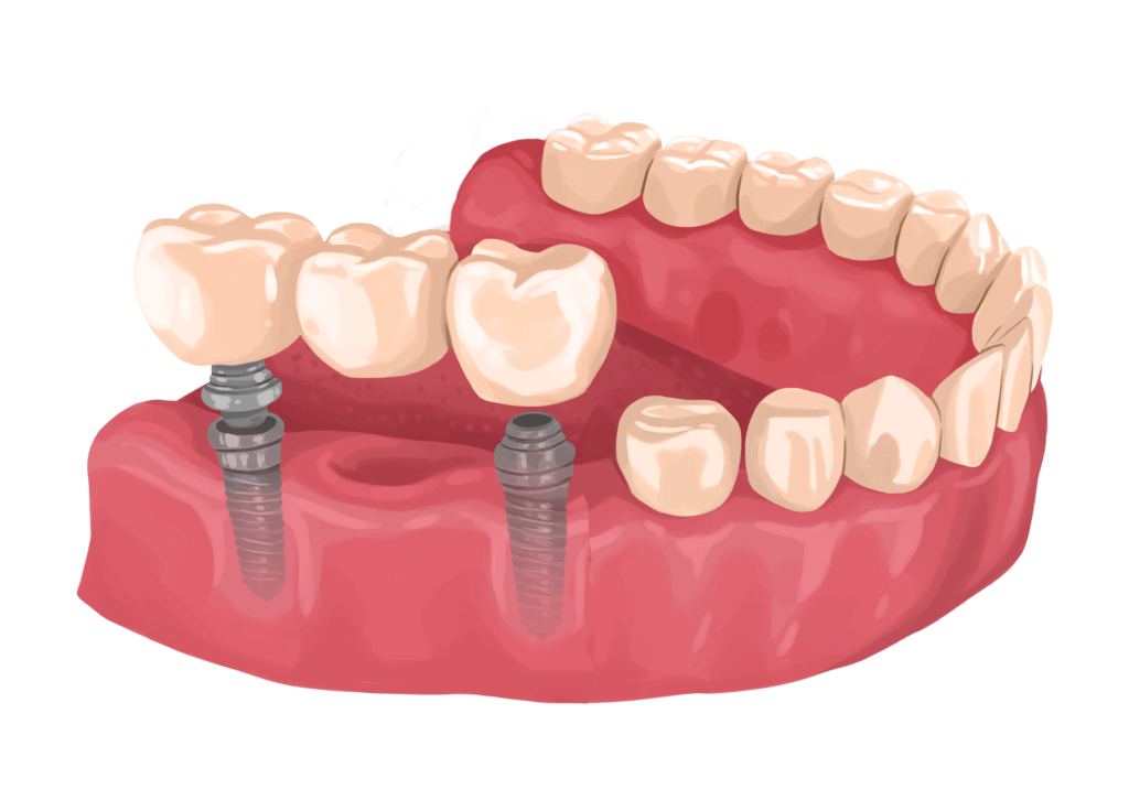 Implant Bridge