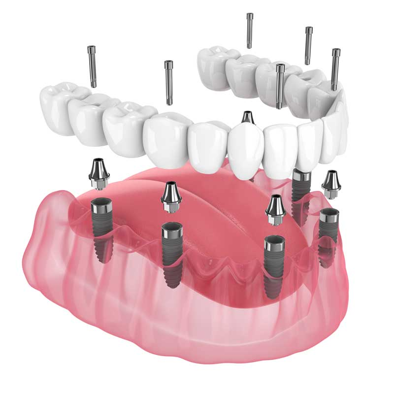 Full Fixed Arch Implants