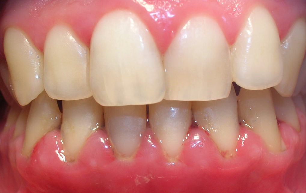 Healthy Gums