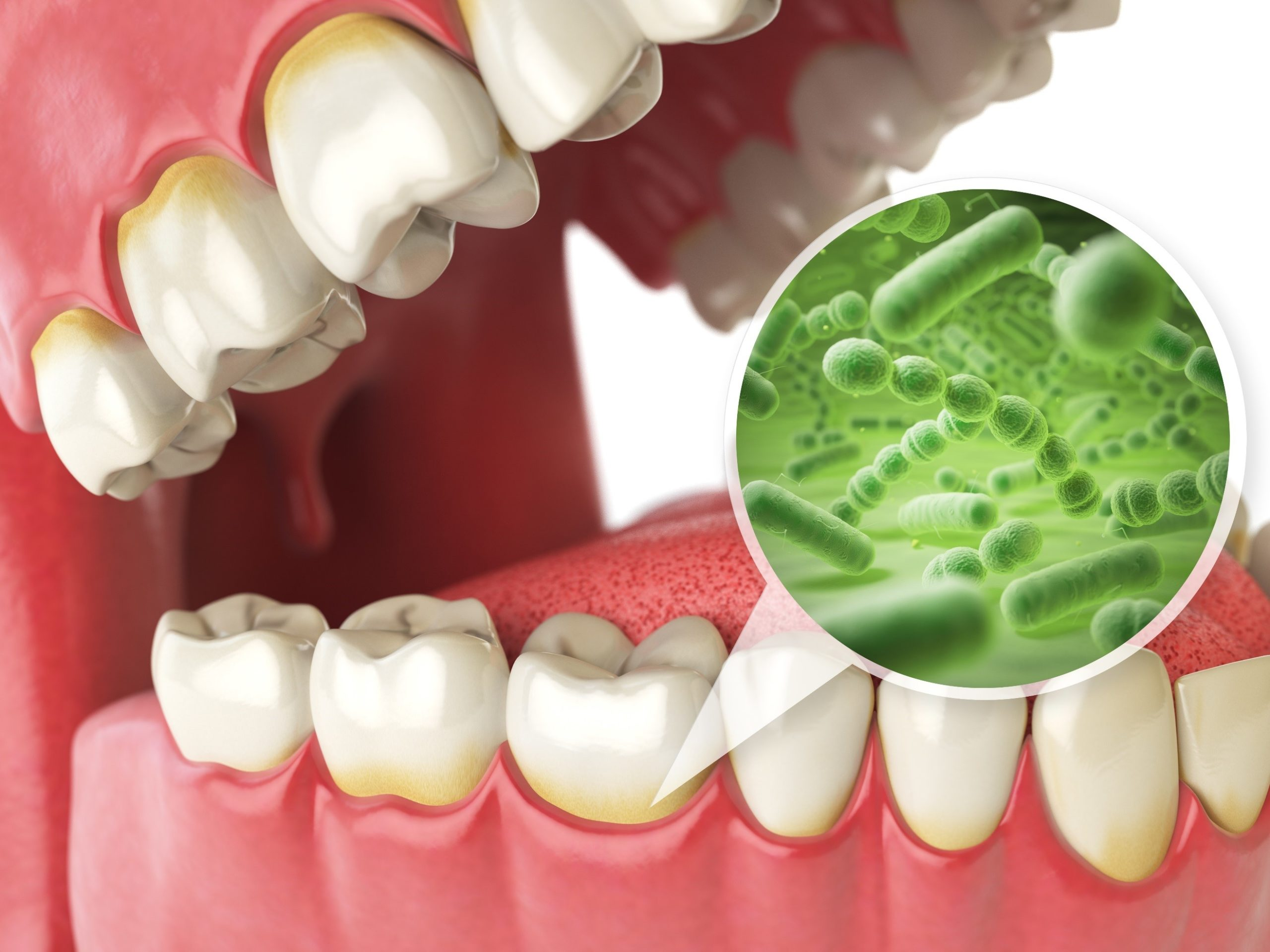 Antibiotic Therapy