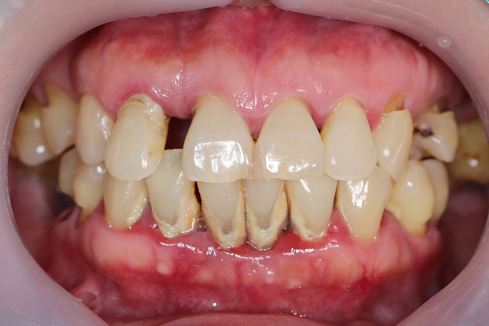 Unhealthy Gums
