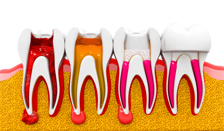 Root Canal Process