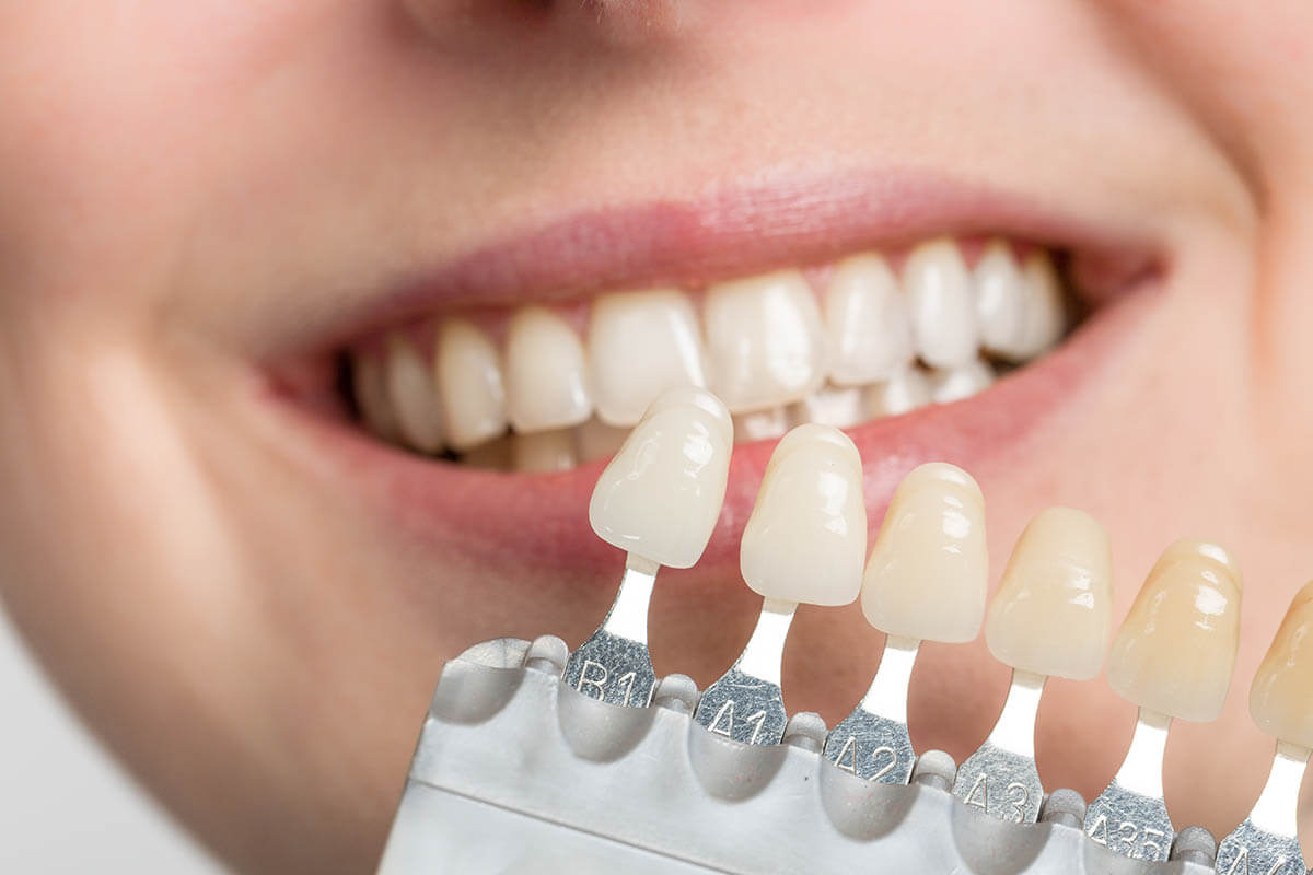 Aesthetic Crowns & Veneers Process